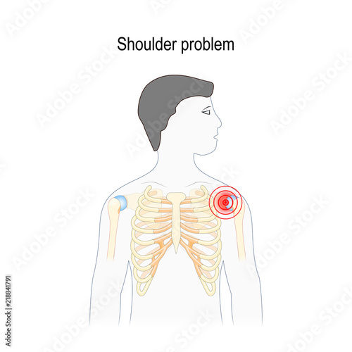 Shoulder problem