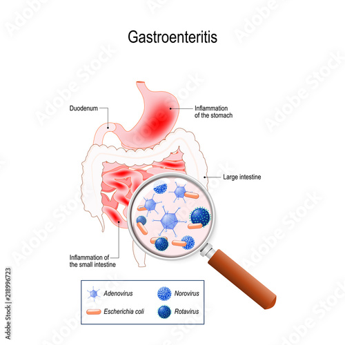 Gastroenteritis photo