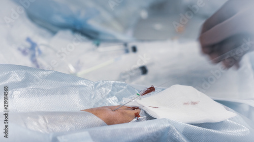 radial artery puncture