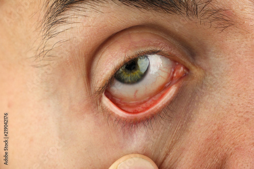 man pulls the lower eyelid to survey the eyeball, closeup macro
