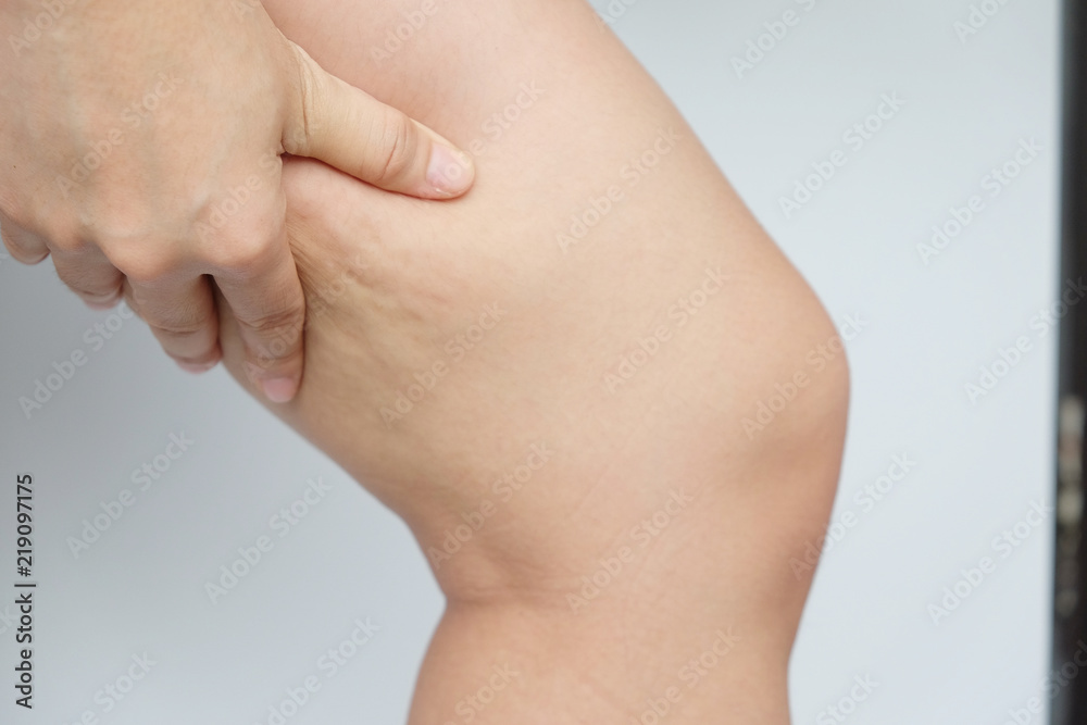 Female legs thighs with cellulite. Skin problem, body care, overweight and dieting concept, diabetic risk factor. Female legs thighs with cellulite. Skin problem, body care, overweight and dieting concept, diabetic risk factor.