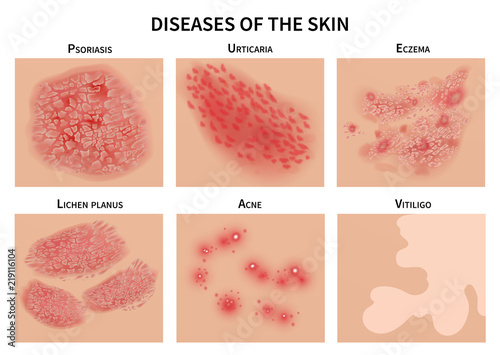 Skin diseases. Derma infection, eczema and psoriasis. Dermatology vector illustration photo