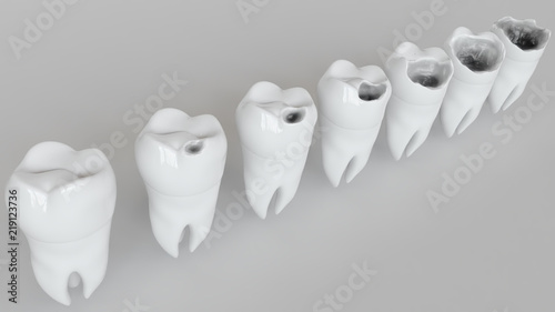 The stages of caries on the molar - 3D Rendering photo