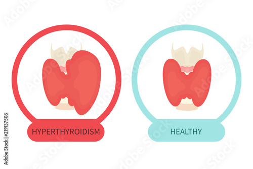 Healthy thyroid gland and hyperthyroidism symbols made in cartoon style. Front view sign. Human body organ anatomy icon. Medical concept. Vector illustration made in cartoon style. photo
