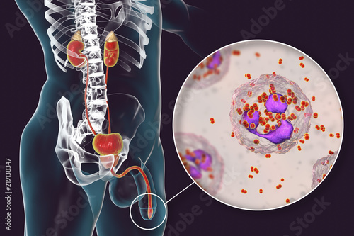 Male gonorrhea, medical concept photo