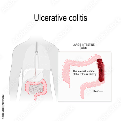 Ulcerative colitis