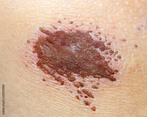 Wound on the skin of a macro