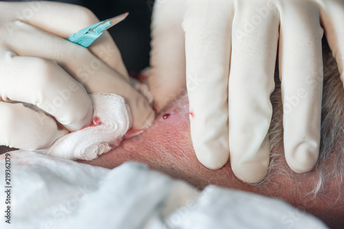 Фотография Gloved Hands of Dermatology Surgeon Using Scalpel to Cut and Drain a Sebaceous C