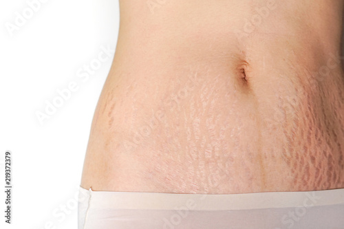 Abdominal scar marked pattern