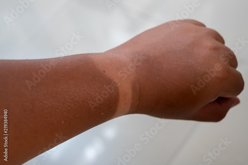 Sunburnt Arm