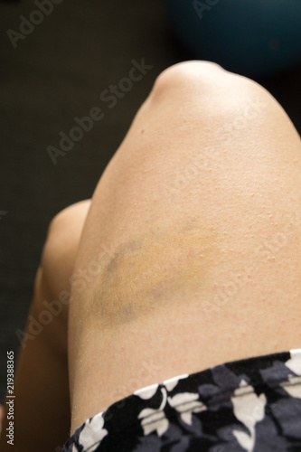 Bruises and scratches on woman's leg. Slovakia