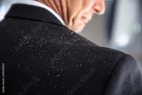 Obraz na plátně Dandruff Fallen On Businessperson's Shoulder
