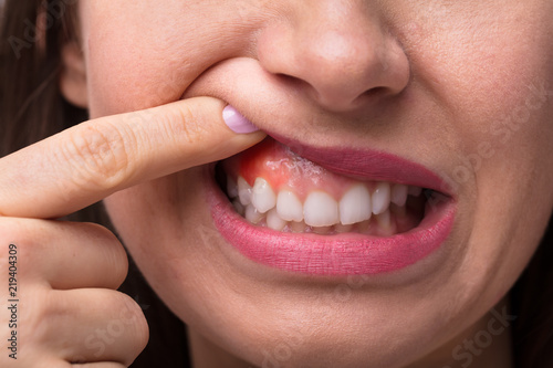 Woman Showing Swelling Of Her Gum photo