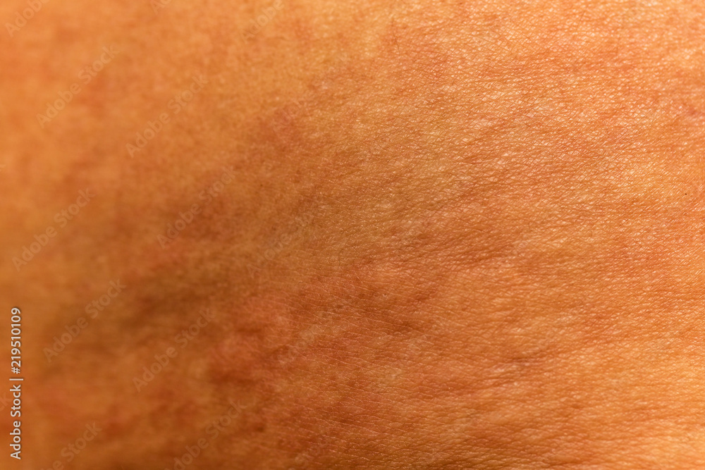 Fototapeta premium Blurred of skin human have red rash from allergies.