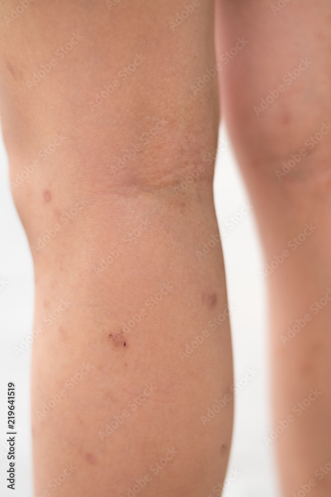 .Selective focus on dried skin legs of Asia kid child with lesions rash as sick from eczema disease or allergy from mosquito bites.Healthcare concept. .Selective focus on dried skin legs of Asia kid child with lesions rash as sick from eczema disease or allergy from mosquito bites.Healthcare concept.