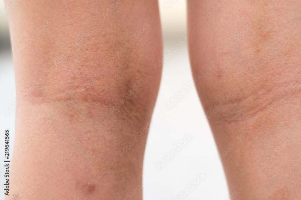Selective focus on dried skin legs of Asia kid child with lesions rash as sick from eczema disease or allergy from mosquito bites.Healthcare concept. Selective focus on dried skin legs of Asia kid child with lesions rash as sick from eczema disease or allergy from mosquito bites.Healthcare concept.