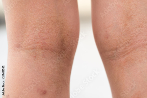 Canvas Print Selective focus on dried skin legs of Asia kid child with lesions rash as sick from eczema disease or allergy from mosquito bites