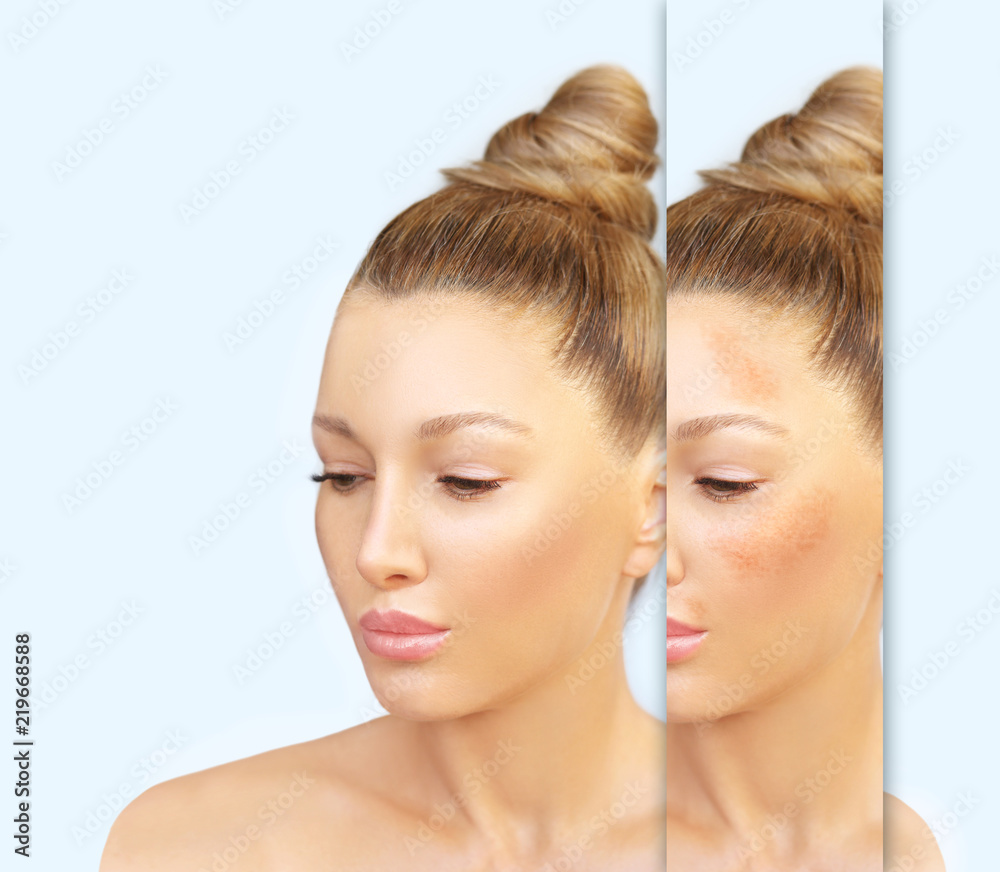 Dark spots, freckles,hyperpigmentation(melasma or chloasma) Dark spots, freckles,hyperpigmentation(melasma or chloasma)