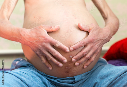 ascites in man, holds his belly with his own hands