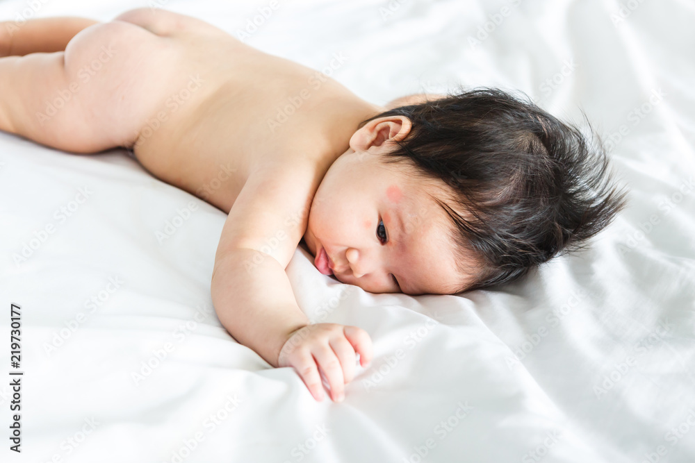 Asian baby girl with red spots on skin face