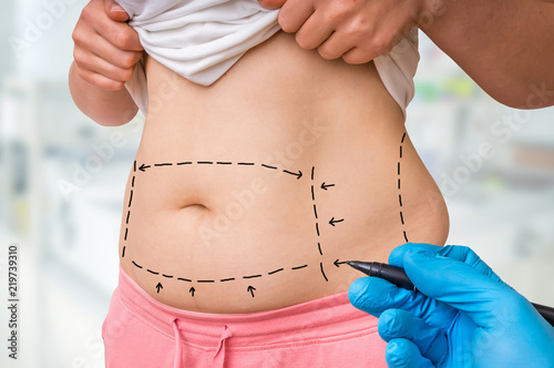 Plastic surgery doctor draw lines with marker on patient belly photo