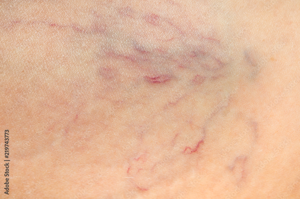 Fototapeta premium Close-up view of spider veins on female leg