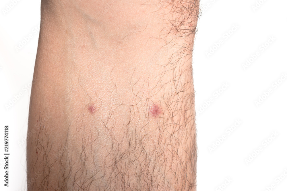 Fototapeta premium red dot on skin from bite bugs