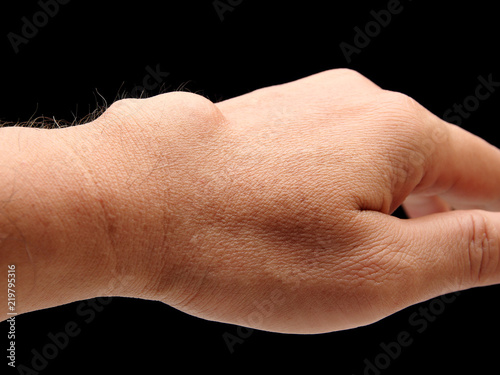 carpal ganglion cyst in wrist on black blackground
