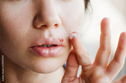 Part of a young woman's face with a virus herpes on lips, treatment with ointment photo
