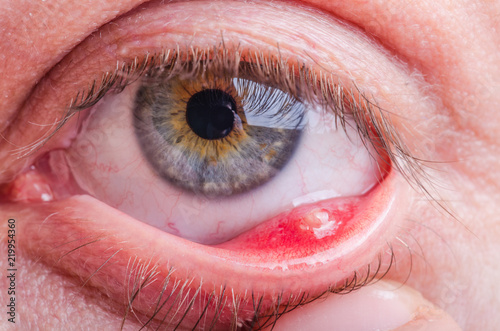 Stye (hordeolum) disease on eye of a caucasian female photo