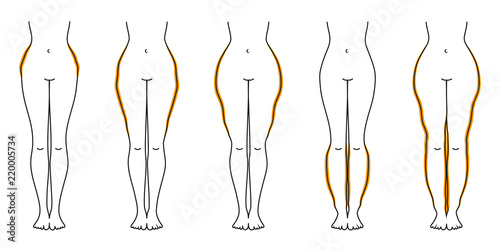 Schaubild Lipödem Orange