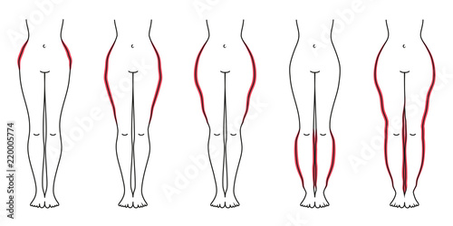 Schaubild Lipödem Pink