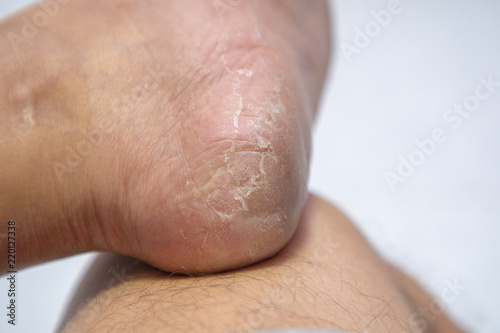 Close up Dermatitis of Heel break, Skin peeling in men on foot. © BBbirdZ