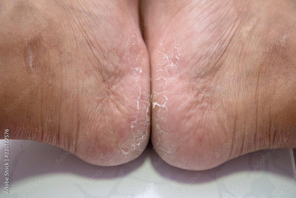 Close up Dermatitis of Heel break, Skin peeling in men on foot. Close up Dermatitis of Heel break, Skin peeling in men on foot.