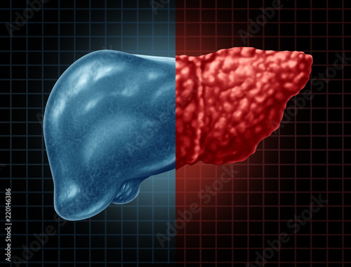 Fatty Liver Disease photo