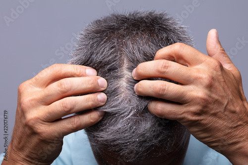 Dandruff On Man's Hair photo