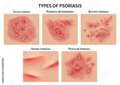 Psoriasis types. Skin hives, derma diseases. Closeup medical vector illustration