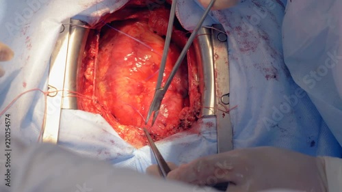 One surgeon uses scissors and a medical needle to sew patient's heart. 4K. photo