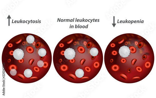 Leukocytosis and Leukopenia. White blood cell count.  photo