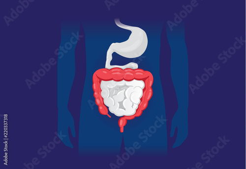 Illustration about abnormal symptom of human large Intestine. Disease about Digestive system.