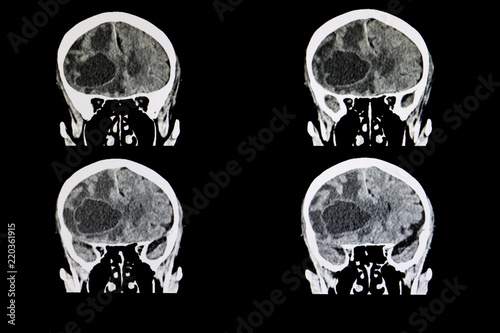 metastatic brain tumor