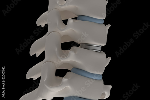 Artificial intervertebral disc prosthesis is installed between the cervical vertebrae isolated on a white 3d render image