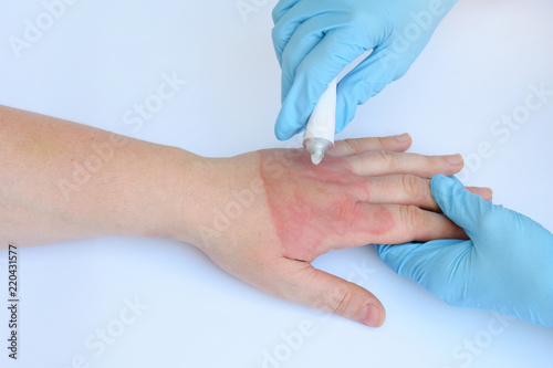 Doctor's hands holding female hand with second degree burns on white background. Treatment of burns by ointment or cream. Patient cheering and support