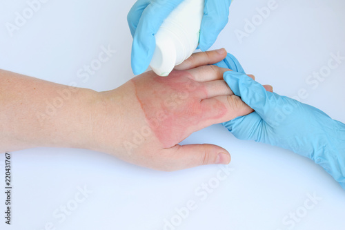 Doctor's hands holding female hand with second degree burns on white background. Treatment of burns by spray. Patient cheering and support