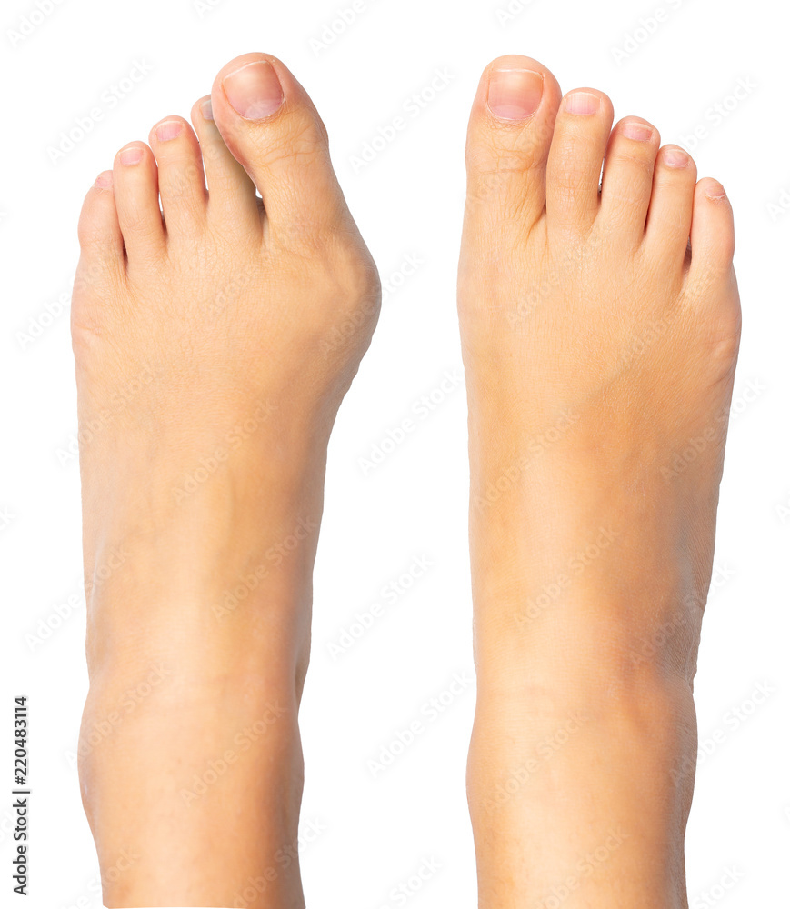 Woman feet with and without bunion Woman feet with and without bunion