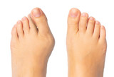 Woman feet before and after surgery for hallux valgus removal