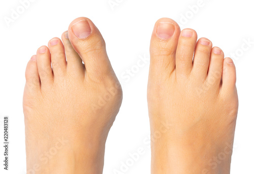 Woman feet before and after surgery for hallux valgus removal photo