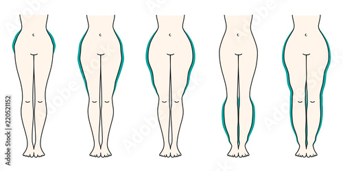 Schaubild Lipödem Türkis