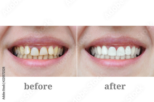 Teeth close-up after dental therapy and whitening. Before and after.