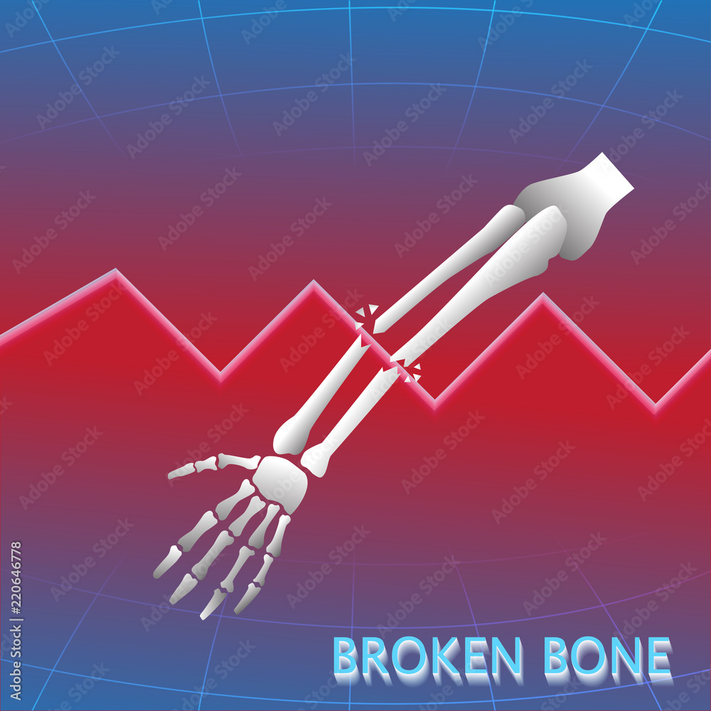 Broken arm bone lateral view show fracture of ulna and radius bone